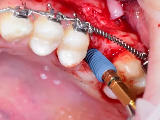 Implant placement with one-stage sinus lift surgery