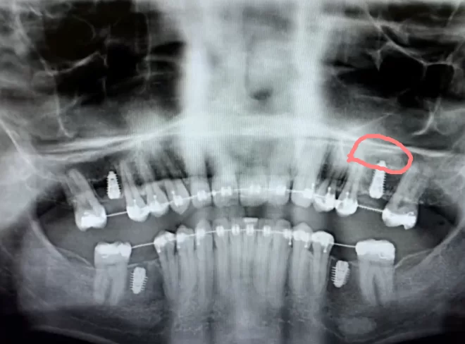 Control image after surgery for placement of 4 implants