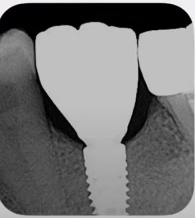 Example of a targeted x-ray of an already placed implant with crown