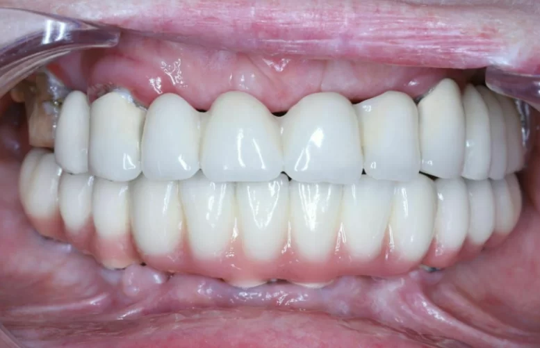 Temporary prosthesis made of pmma plastic - the patient's living teeth affected by caries are visible on the sides