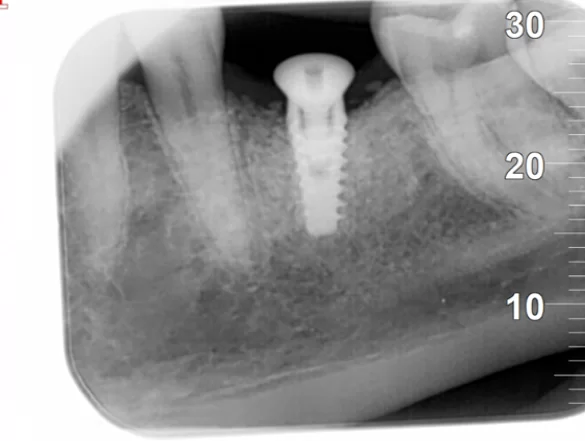 Single implant screw-retained restoration after extraction of a tooth affected by cystic granuloma single implant screw retained restoration after extraction of a tooth affected by cystic granuloma 2
