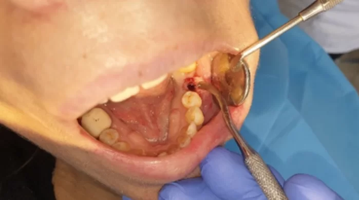 Single implant screw-retained restoration after extraction of a tooth affected by cystic granuloma single implant screw retained restoration after extraction of a tooth affected by cystic granuloma
