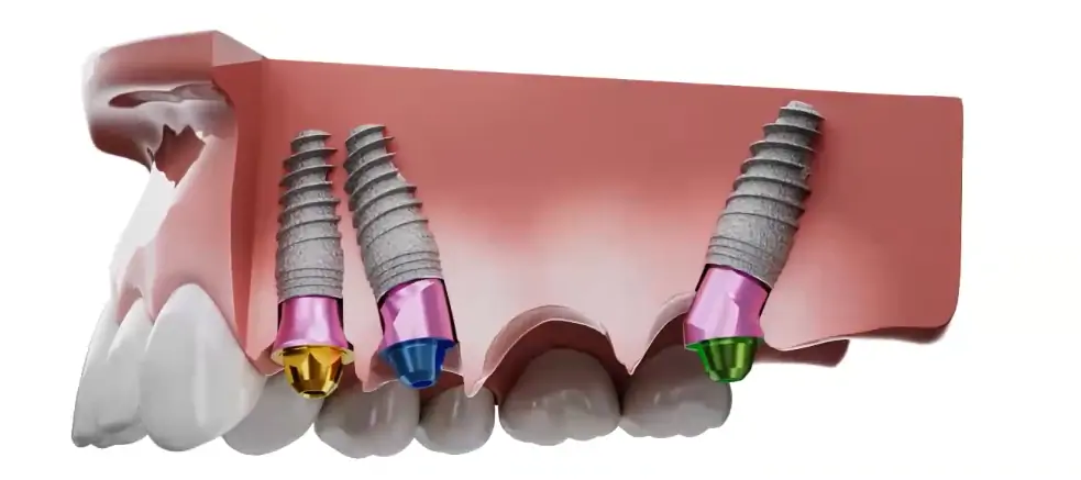 angled abutments with screw fixation