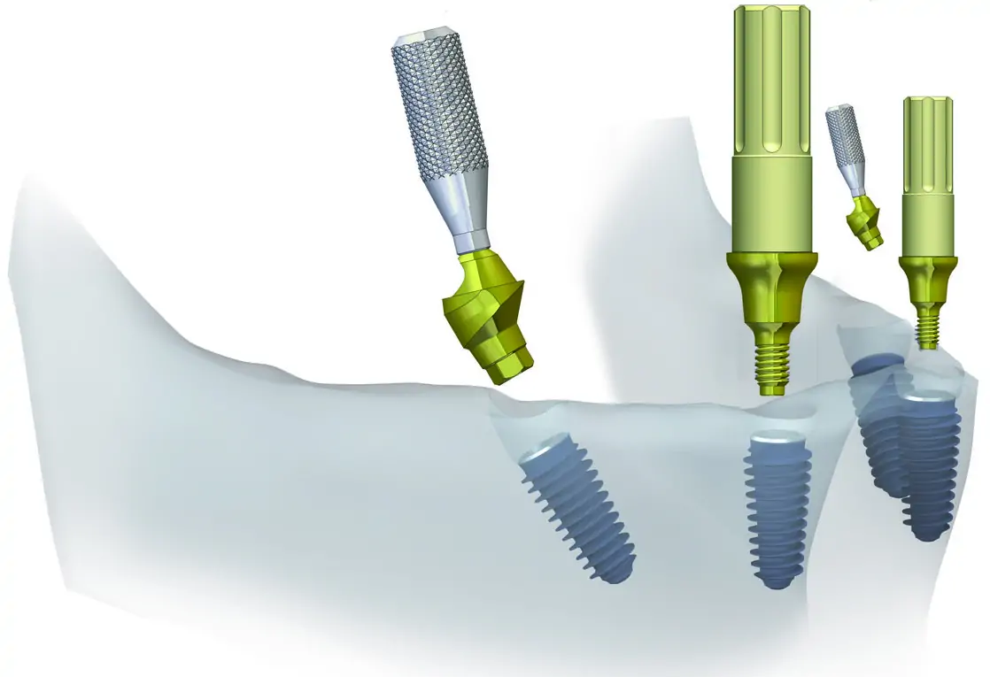 Lower jaw implantation model all on 4 - angled and straight multi-unit abutment placement stage