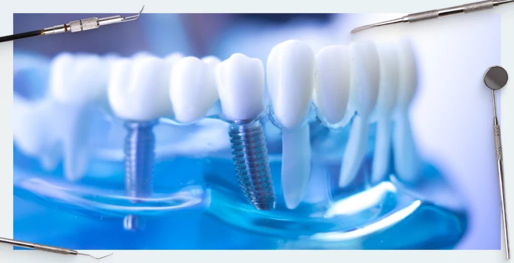 What are full-arch dental implants?