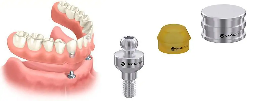 An illustration showing dental implant components including the abutment, implant, and prosthetic crown, providing an overview of how the parts work together for a complete restoration.