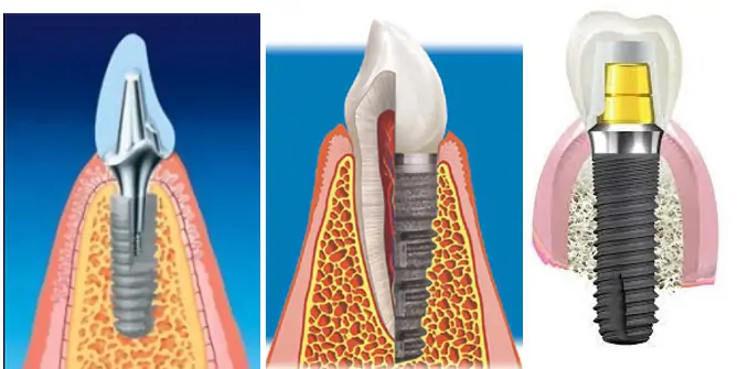 Illustration of dental implant components - subcrestal, subgingival, and transgingival placement