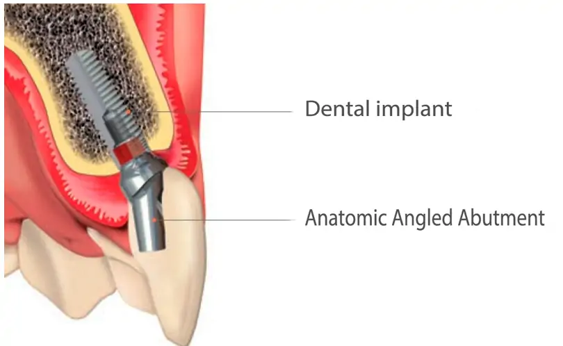 shape of angled abutments