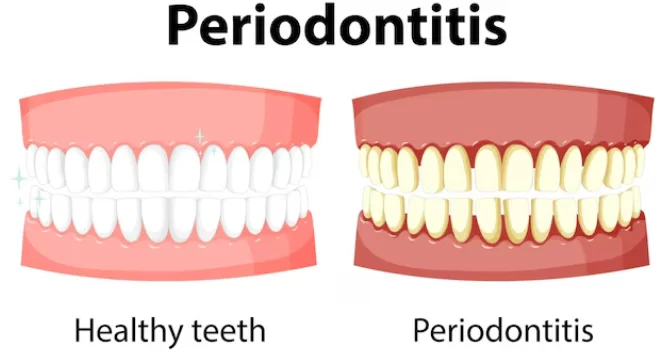 Advancements in understanding and treating periodontitis through improved mouse models advancements in understanding and treating periodontitis through improved mouse models