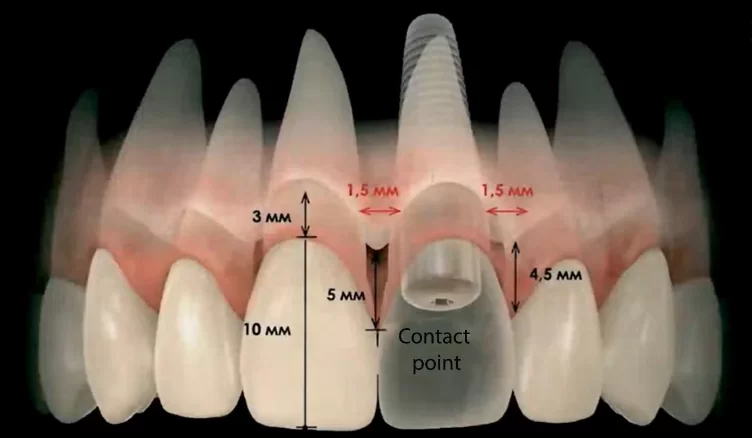 Recommended implant position for one-stage implantation in the smile area