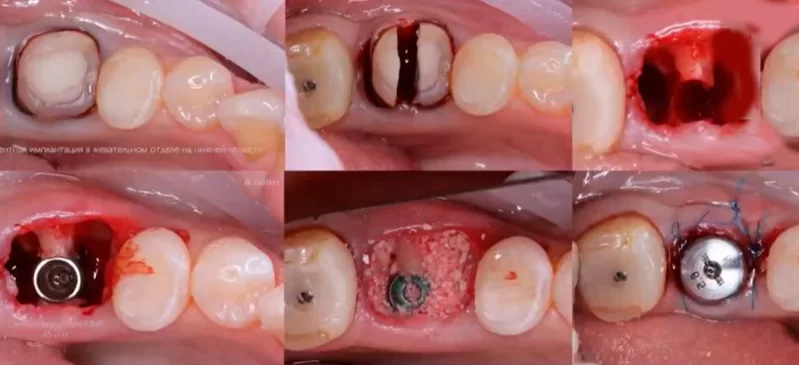 Stages of immediate implantation from tooth extraction to the installation of the healing cap and soft tissue suturing