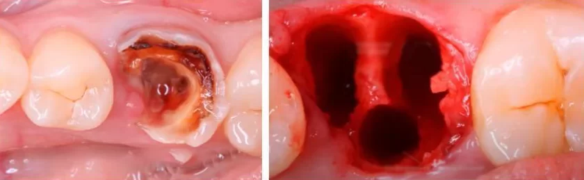 Tooth extraction and preparation of the hole for implant installation