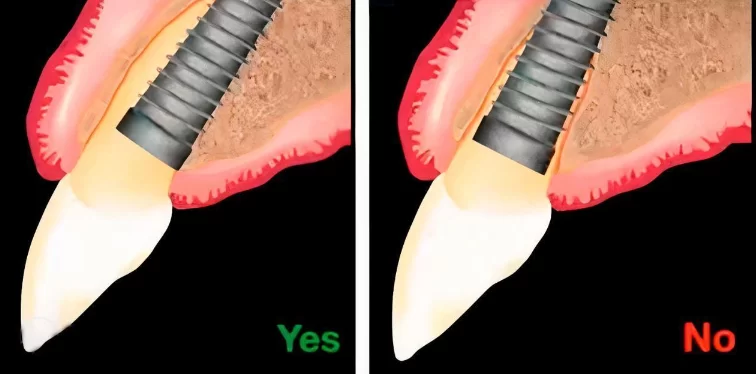 Correct (left) and incorrect (right) position of the implant