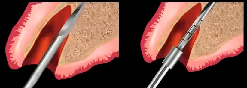 Creation of a depth for the implant hole with a lance drill and passing through with the first drill bit