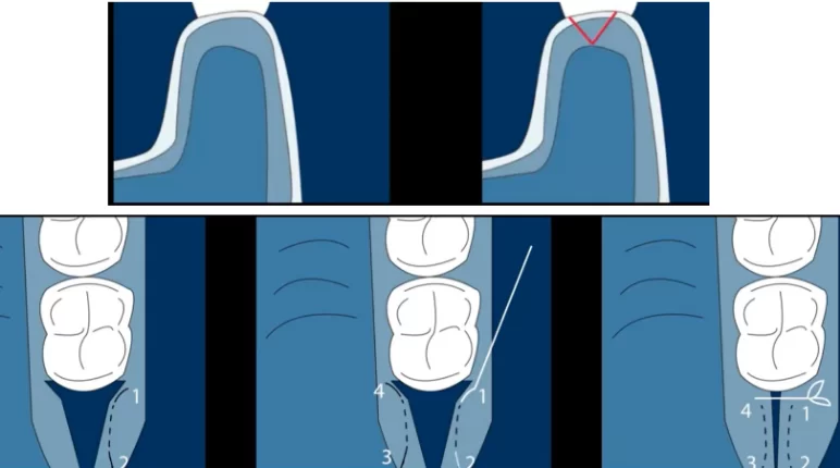 Protocol for extracting an sctg from the tuberosity of the maxilla