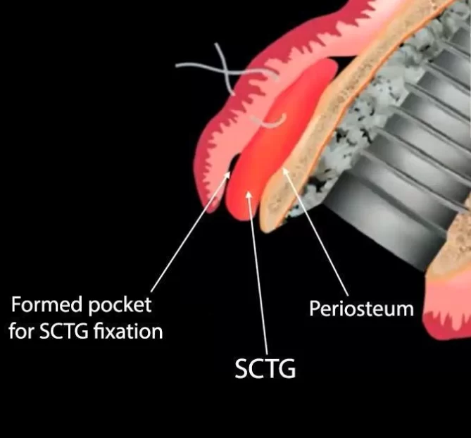 Installation scheme subepithelial connective tissue graft (sctg)