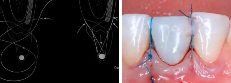 Hurzeler-zuhr suture for gingival fixation in cases of single-stage implantation with immediate crown installation