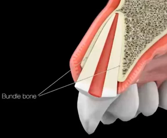 Bundle bone in the case of a thin biotype - the outer bone plate consists entirely of bundle bone