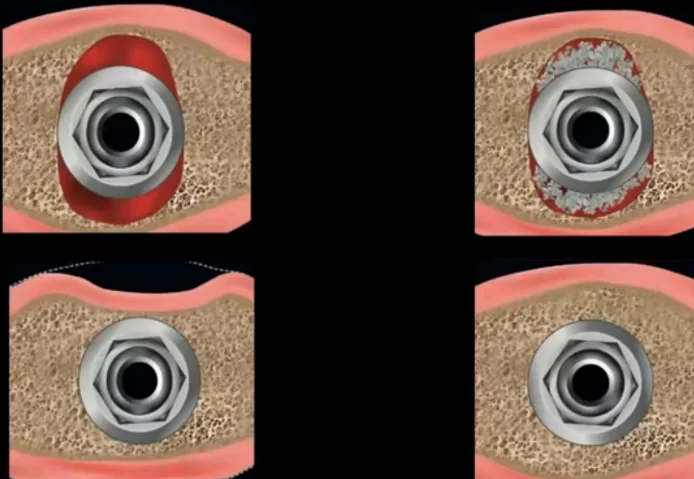 Comparison of healing results without bone graft and with filling the defect with bone material - without bone graft there is a significant loss of bone volume on the vestibular side