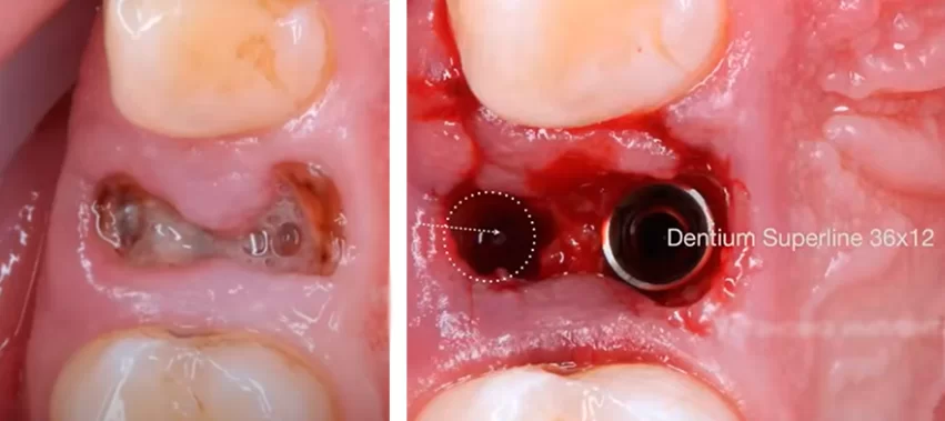 Installation of the implant in the palatal wall in the case of immediate implantation in the maxilla