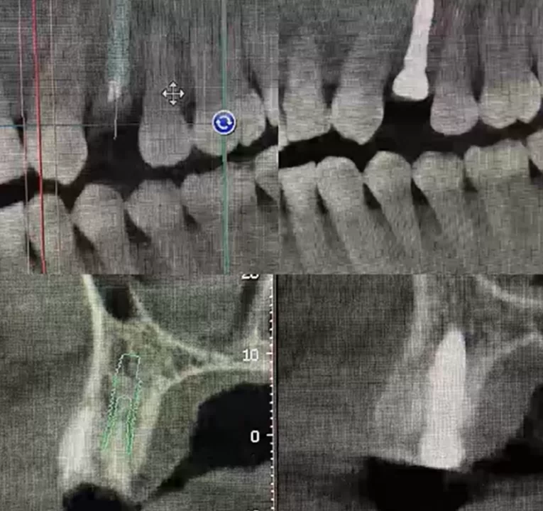 The pictures confirm the minimal deviations of the actual implant position from the planned position at the beginning of the surgery