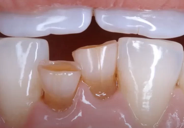 Image of the initial picture of a patient with adentia of the lower incisors