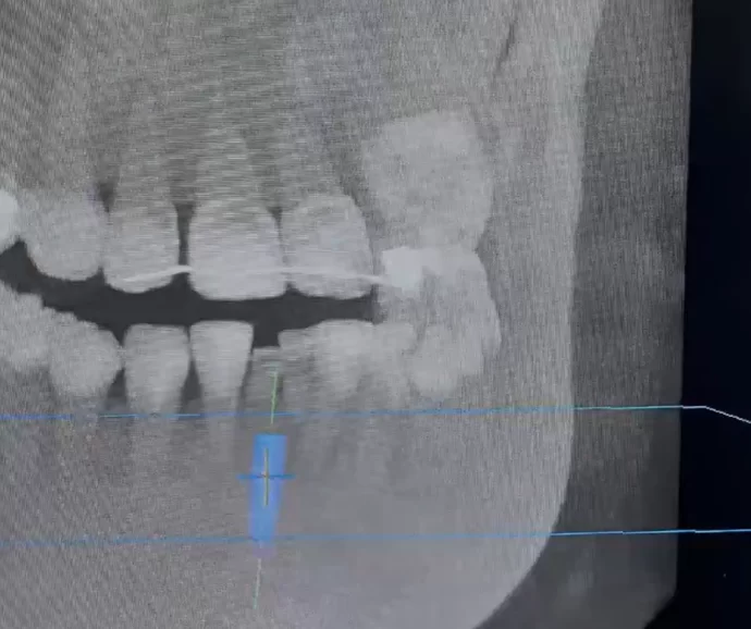 Planning the implant location on the cbct images