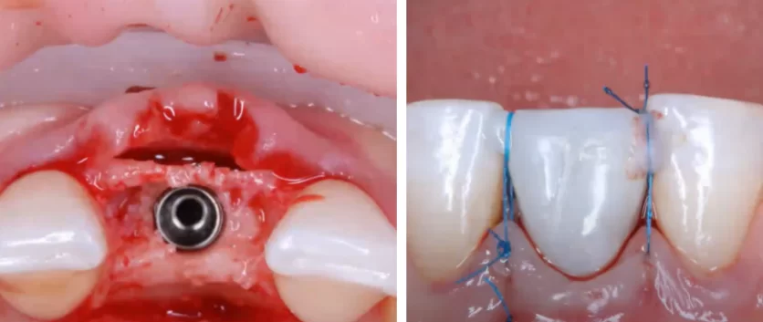 Implant and temporary crown with soft tissue fixation using hurzeler-zuhr suture