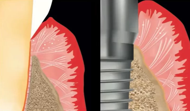 Difference of soft tissue connection between tooth and implant