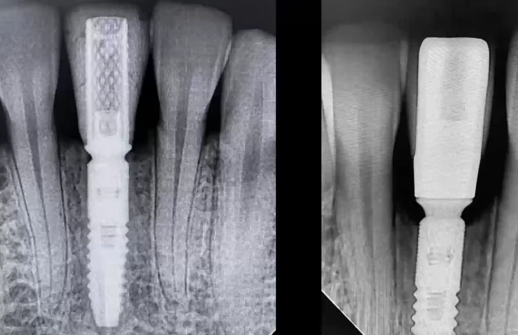 Immediately after surgery and 5 months later - you can see that the bone crest height is almost intact