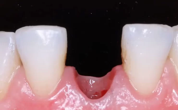 Condition of the papillae and soft tissue contour before installation of the permanent crown