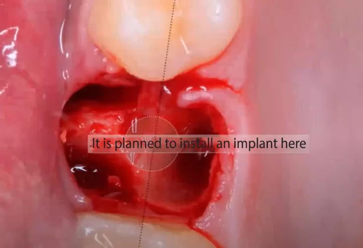 Hole ready for preparation and implant installation