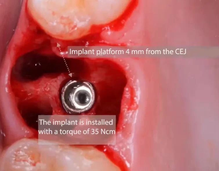 The implant is installed with a torque of 35 ncm, the distance to the cement-enamel joints of the neighbouring teeth is 4 mm - this is a successful implant installation