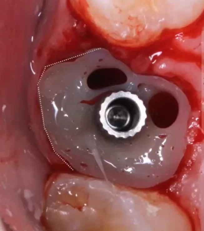 Intermediate stage of manufacturing a customised abutment - liquid composite is applied around the temporary abutment and then illuminated with uv light