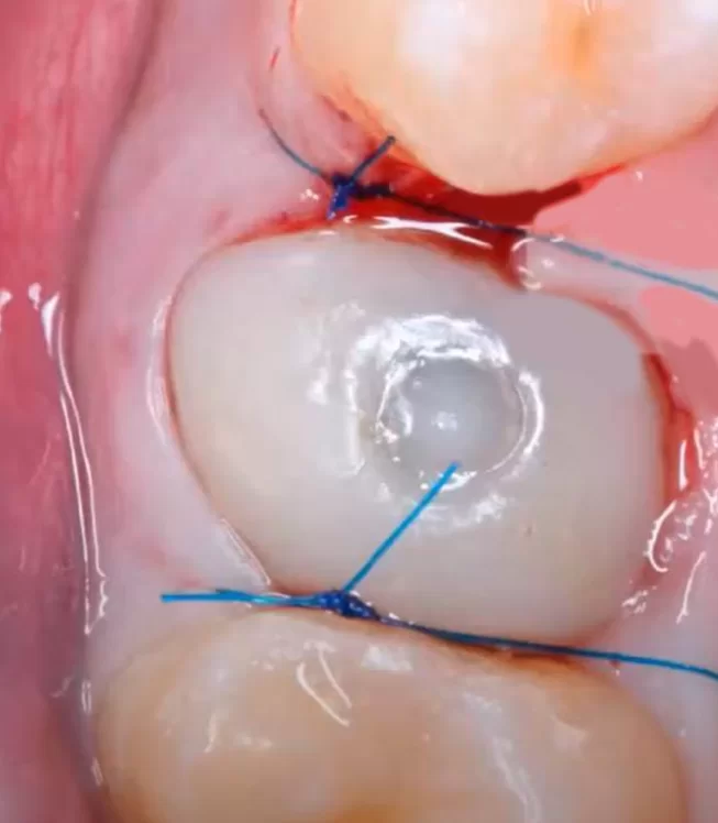 Completion of the surgery with installation of the customised healing cap and suturing of the soft tissues