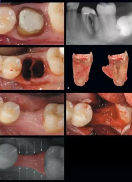 Changes in bone volume and amount of keratinisedized attached gingiva six months after tooth extraction