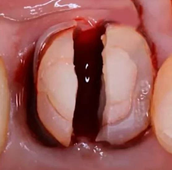 Preparing for tooth extraction - sectioning of the tooth and separation of the circumferential ligament