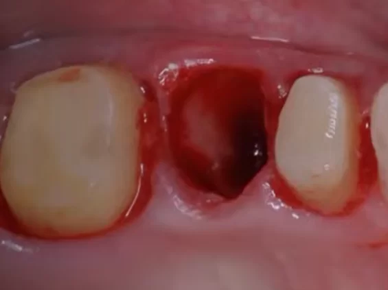 A neat hole after extraction of a single-rooted tooth