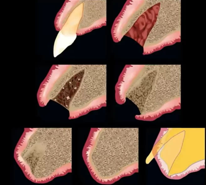 Stages of healing after tooth extraction - the illustration shows the loss of bone and soft tissue levels during the healing process