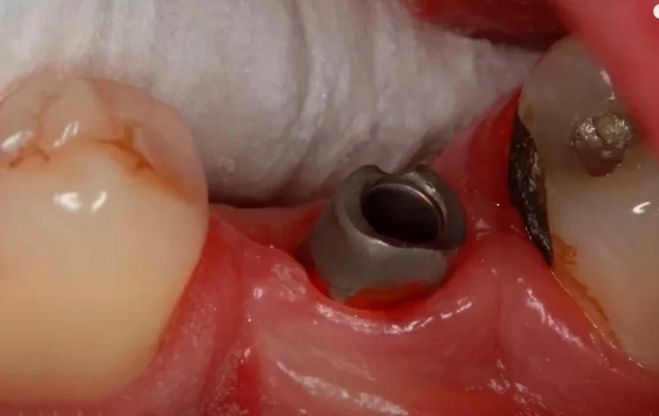 The patient's gingival thickness is too thick for this type of abutment - cemented crowns are not recommended under these conditions