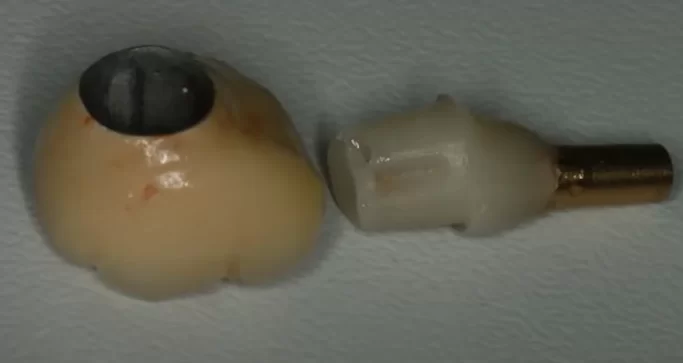 Crown and abutment duplicate for cement placement into the inner cavity of the crown