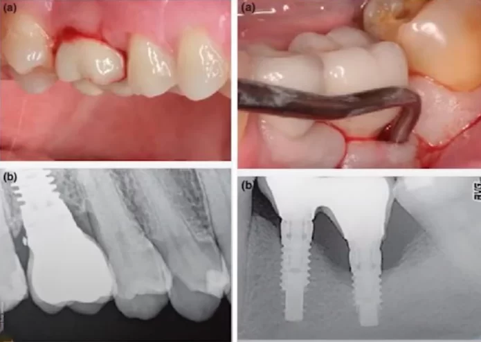 Inflammation and suppuration in the area of cement-retained restorations