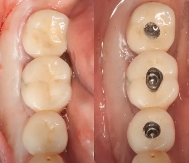 Screw shafts on a screw-retained restoration