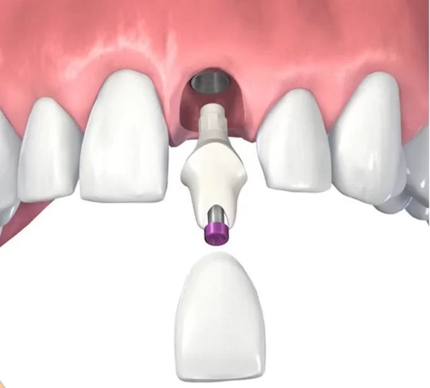 Cement fixation on a customized ceramic abutment