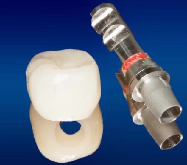 Crown with screw shaft and abutment prepared for screw retention of the prosthesis