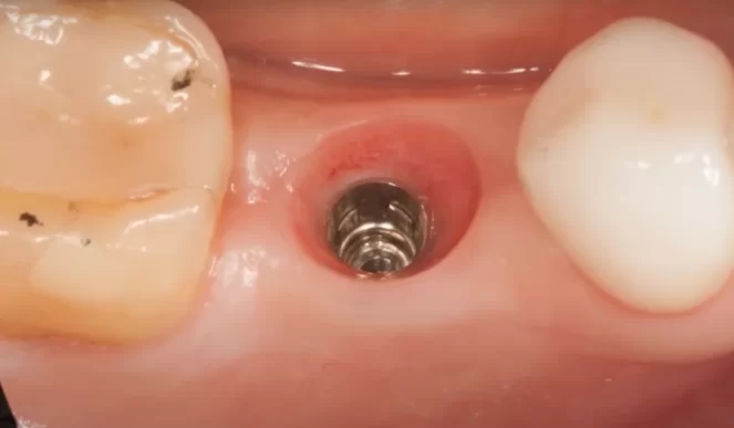 A single implant is placed in a good prosthetic position