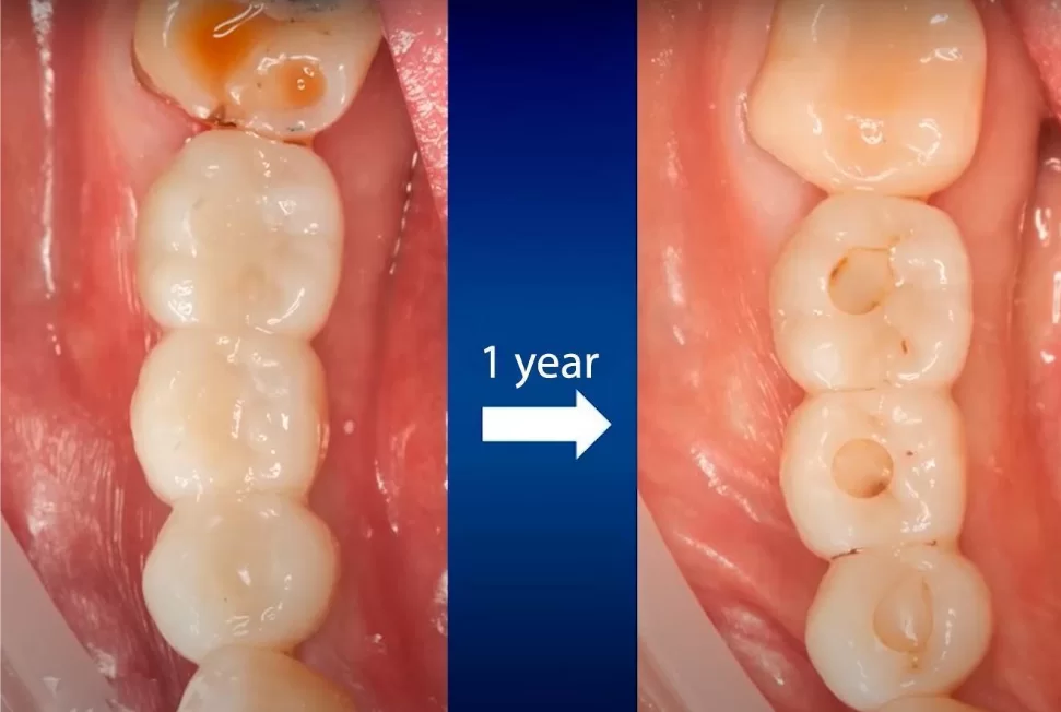 Darkening of the screw shafts of screw-retained dentures one year after the installation of the denture