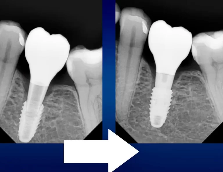 Problems in getting the abutment into position
