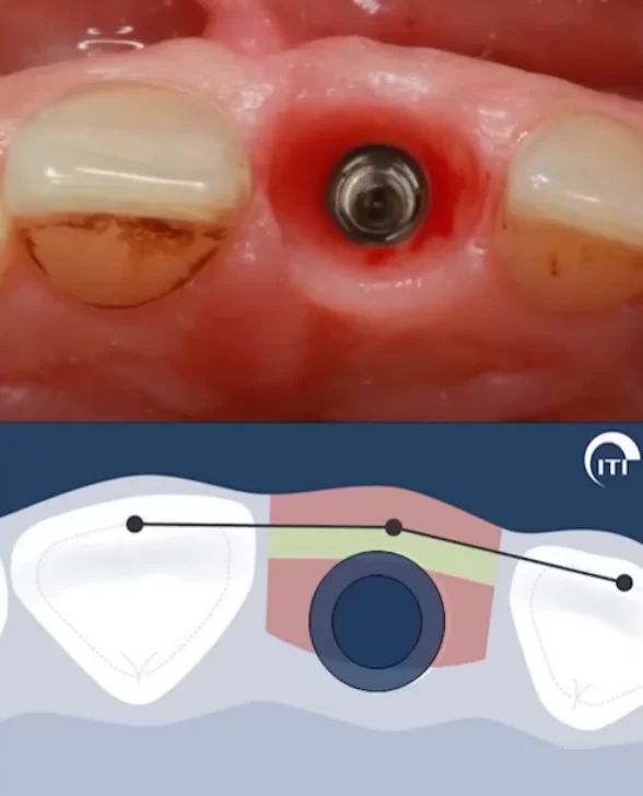 Recommended orthopedically correct position of the implant
