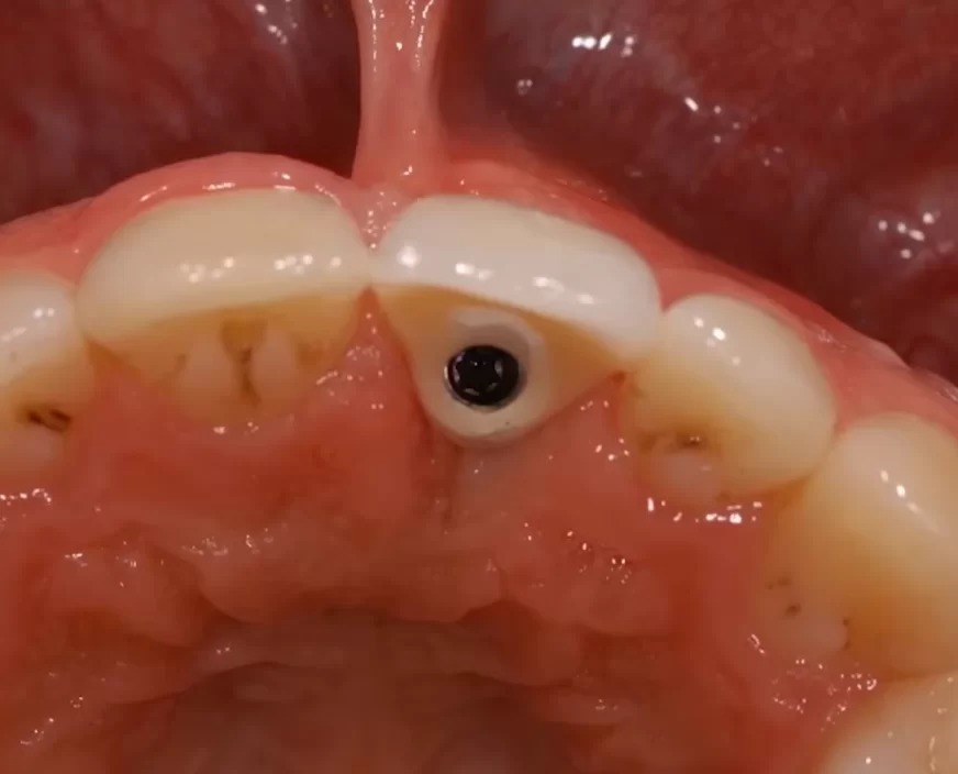 Peek temporary crown with screw shaft extending into the cingulum area